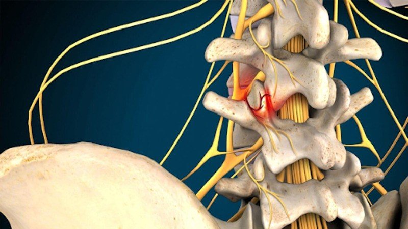 facet joint syndrome