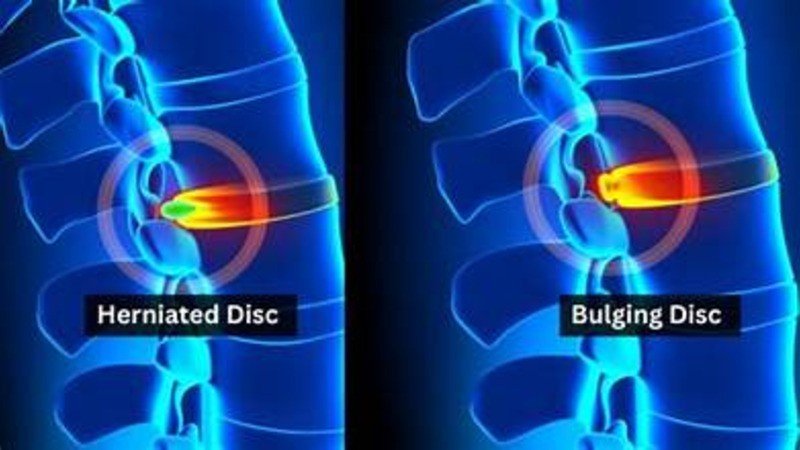 bulging disc