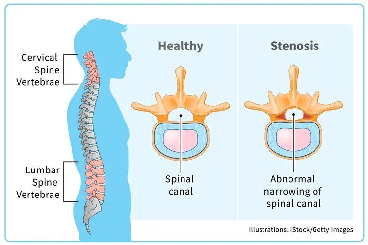 stenosis-spinal